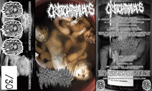 Cryptophthalmos : Cryptophthalmos - Pneumonia Cryptophthalmos : Cryptophthalmos - Pneumonia